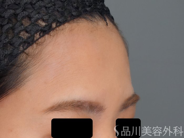 症例NO.69709のBEFORE写真