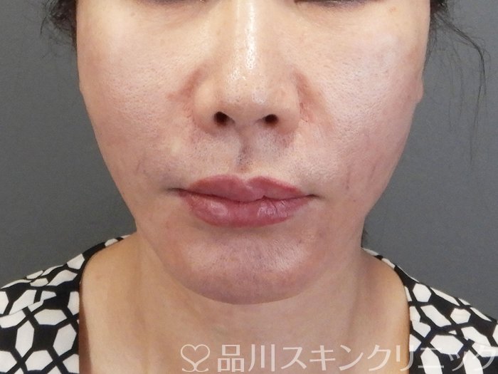 症例NO.75178のAFTER写真