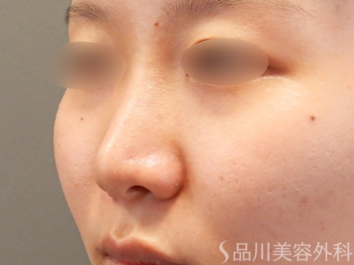 症例NO.71910のAFTER写真