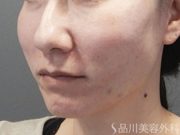 症例NO.72103のAFTER写真