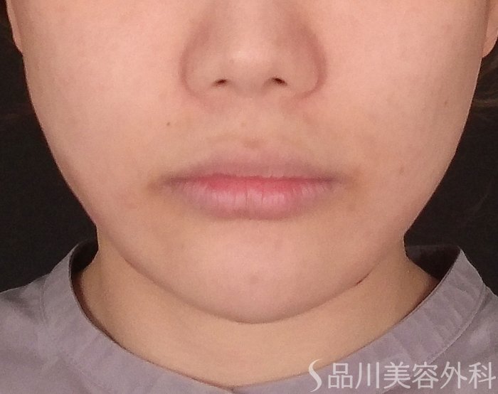 症例NO.70069のAFTER写真