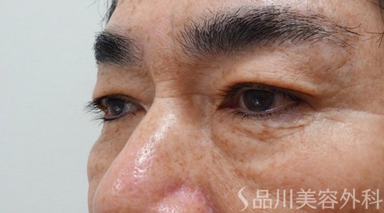 症例NO.69799のBEFORE写真