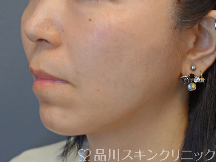 症例NO.73890のBEFORE写真