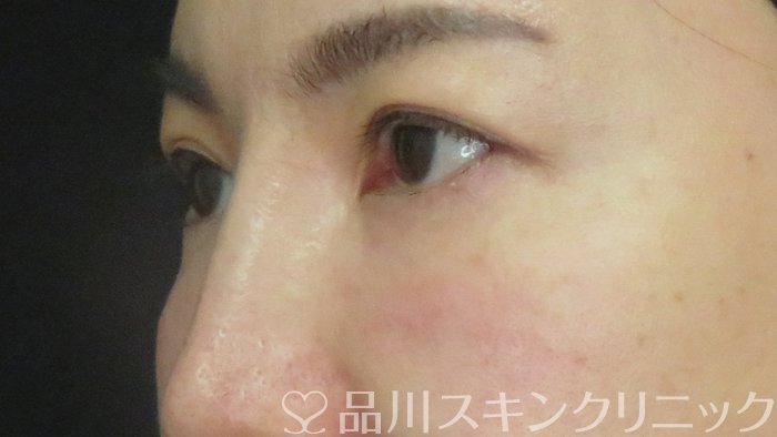 症例NO.71851のAFTER写真