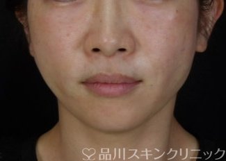 症例NO.72072のAFTER写真