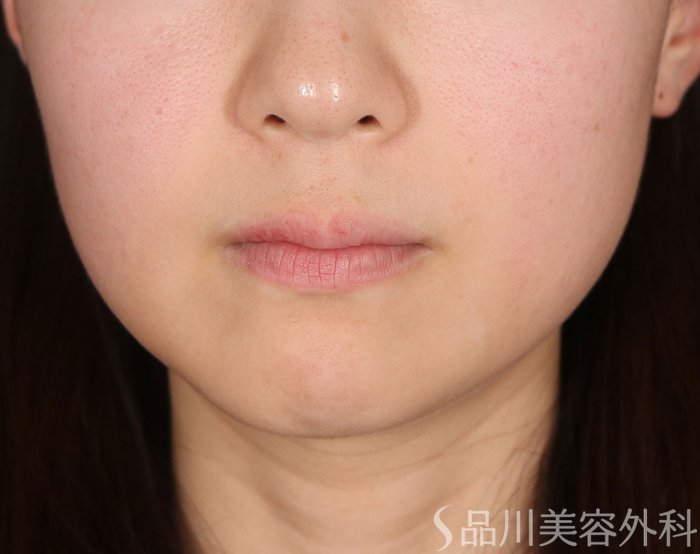 症例NO.73369のBEFORE写真