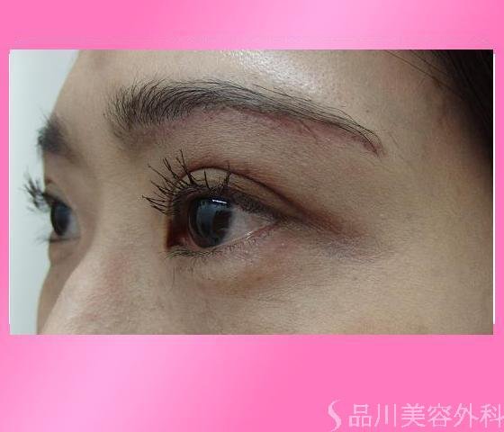 症例NO.13172のAFTER写真