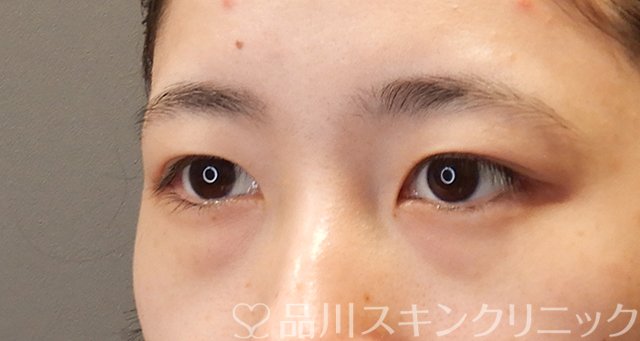 症例NO.75057のBEFORE写真