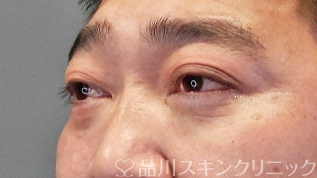 症例NO.64614のAFTER写真