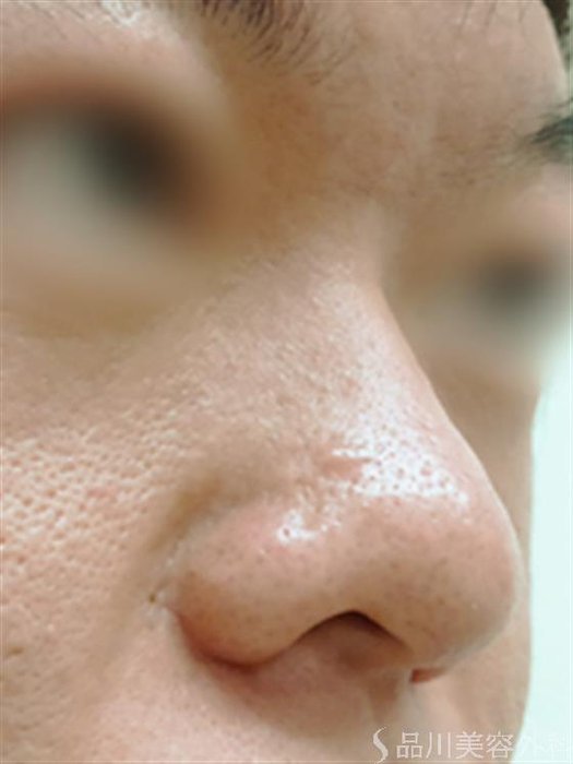 症例NO.23298のBEFORE写真