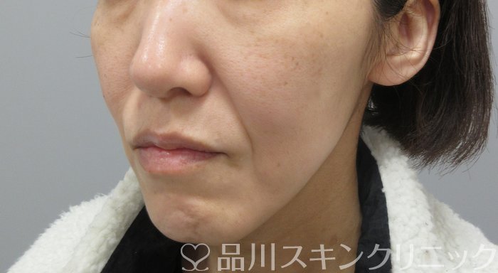 症例NO.69837のBEFORE写真