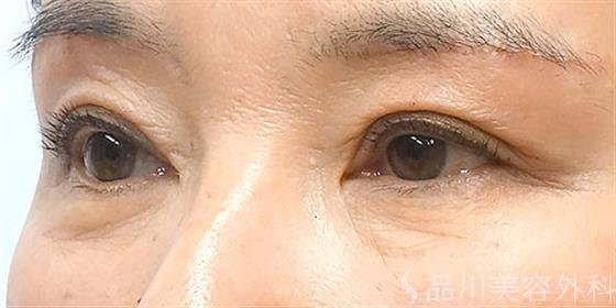 症例NO.21037のAFTER写真