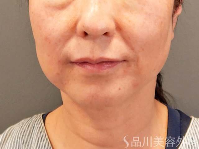 症例NO.70433のAFTER写真