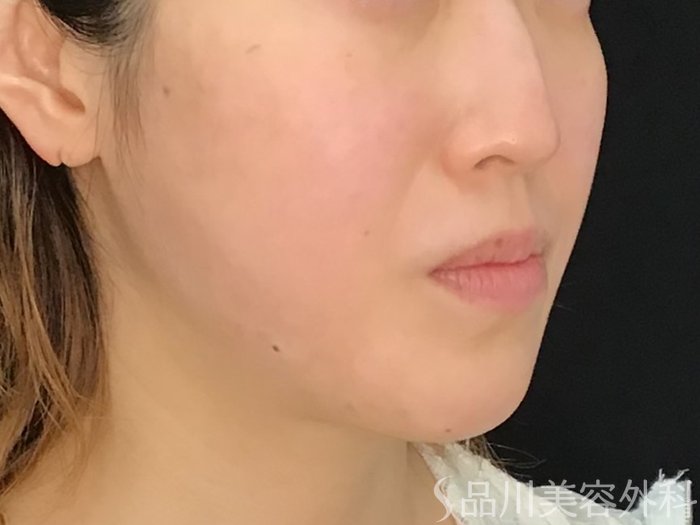 症例NO.71553のBEFORE写真