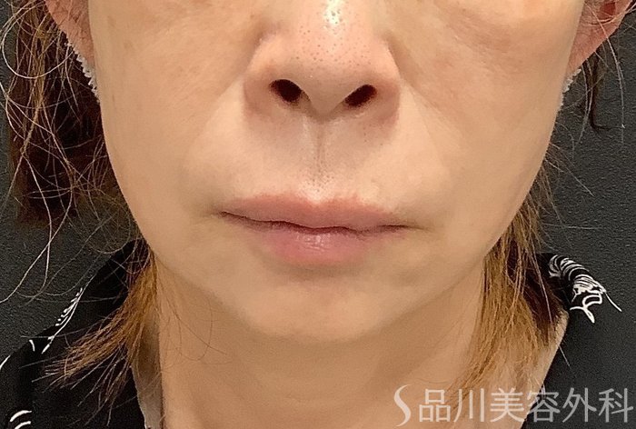 症例NO.75048のAFTER写真