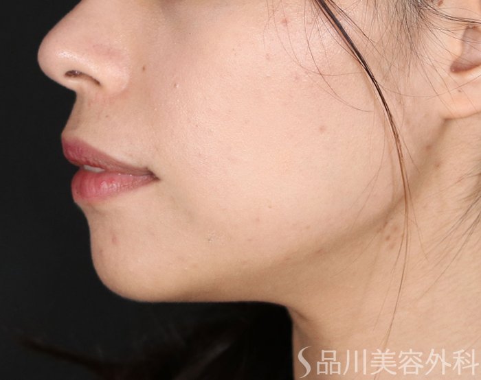 症例NO.71959のAFTER写真