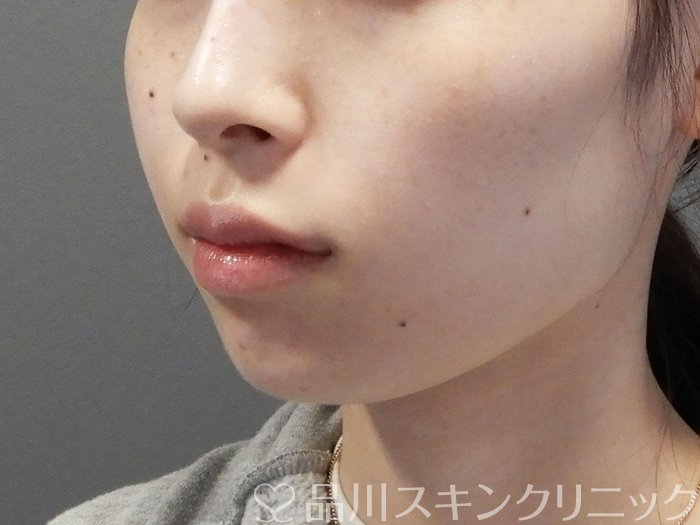 症例NO.70601のBEFORE写真