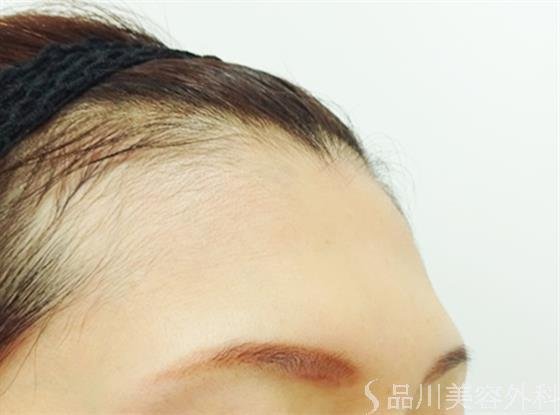 症例NO.42818のBEFORE写真