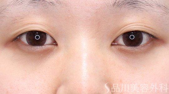 症例NO.70006のBEFORE写真