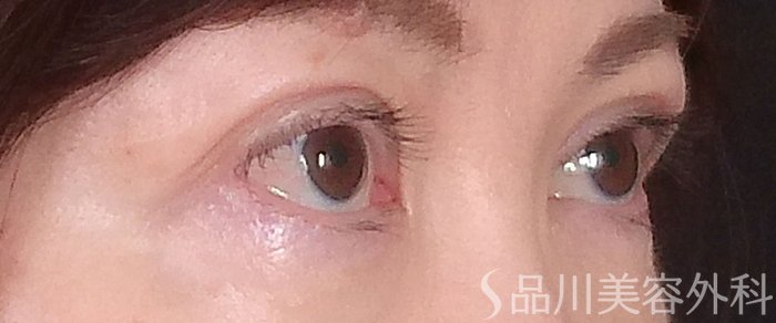 症例NO.70004のAFTER写真