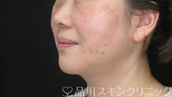 症例NO.73056のAFTER写真