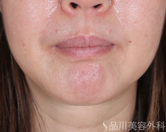 症例NO.72289のBEFORE写真