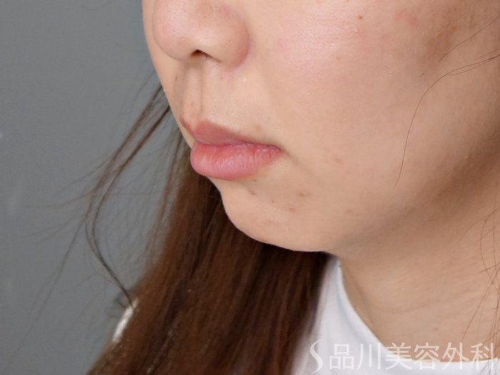 症例NO.70968のBEFORE写真