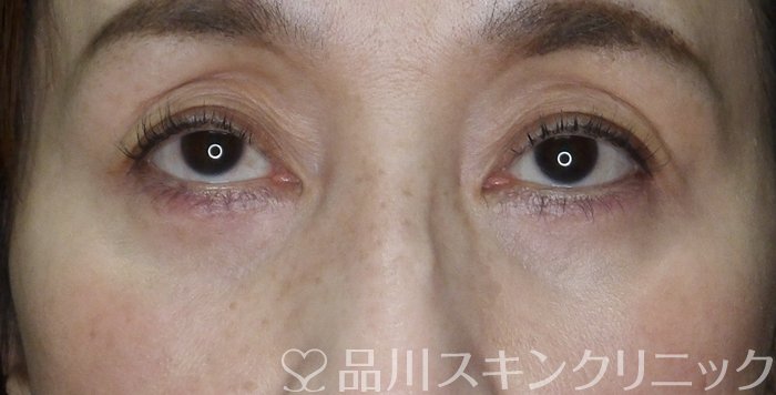 症例NO.68037のAFTER写真