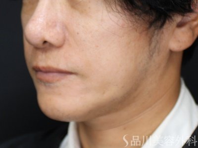 症例NO.72871のAFTER写真