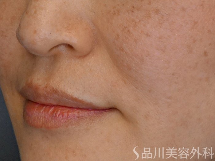 症例NO.68201のBEFORE写真
