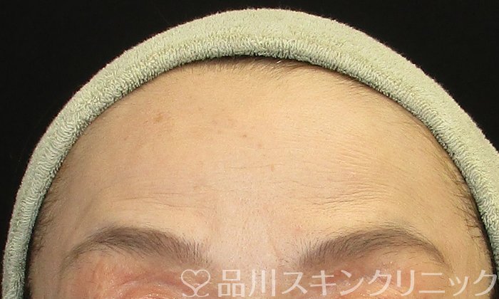 症例NO.74206のBEFORE写真