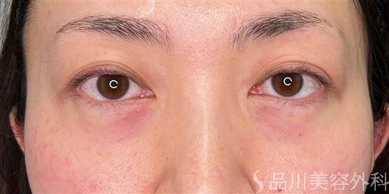 症例NO.54606のAFTER写真