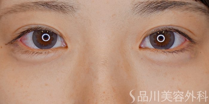 症例NO.71324のAFTER写真