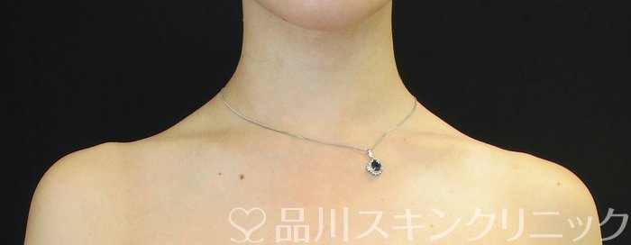 症例NO.73389のAFTER写真