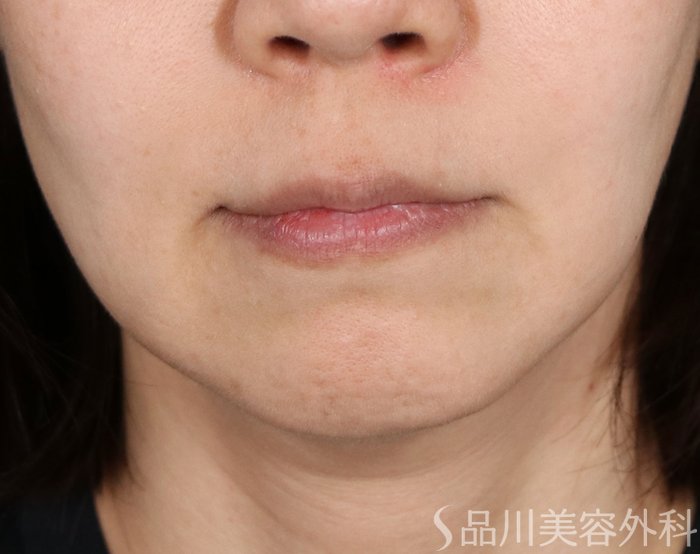 症例NO.71588のBEFORE写真
