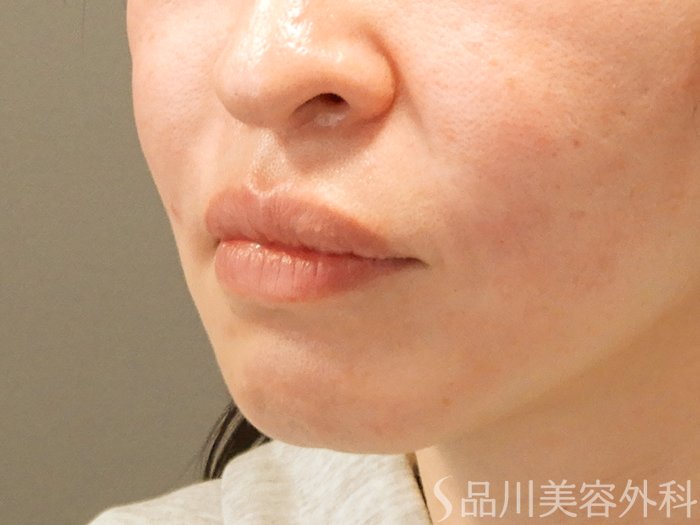 症例NO.69537のAFTER写真
