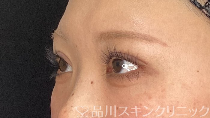 症例NO.75394のAFTER写真