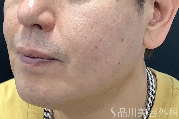 症例NO.75305のAFTER写真