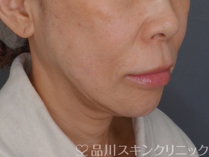 症例NO.72448のAFTER写真