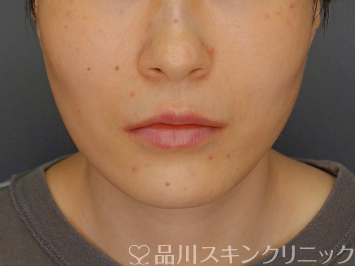 症例NO.71490のAFTER写真