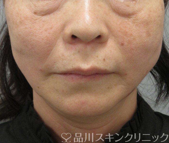 症例NO.74802のAFTER写真