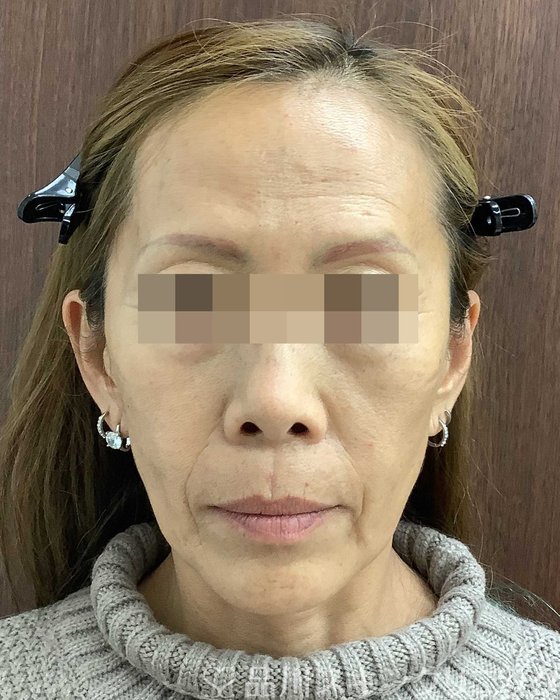 症例NO.69616のBEFORE写真