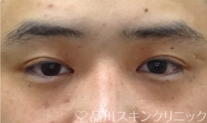 症例NO.69397のAFTER写真