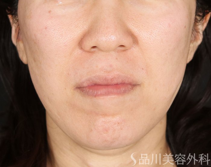 症例NO.72703のAFTER写真