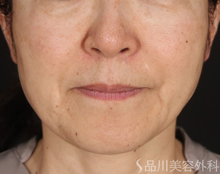 症例NO.73516のBEFORE写真