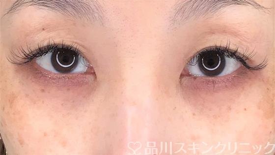 症例NO.54668のAFTER写真