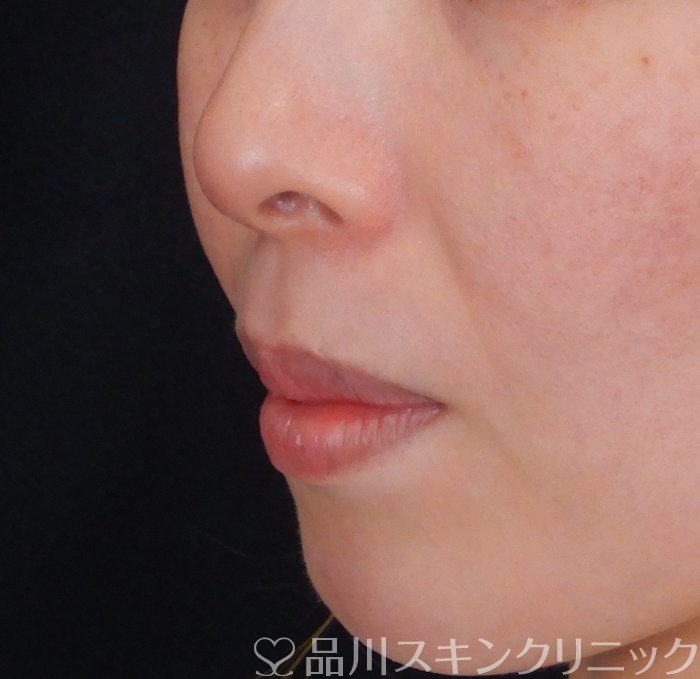 症例NO.66085のBEFORE写真