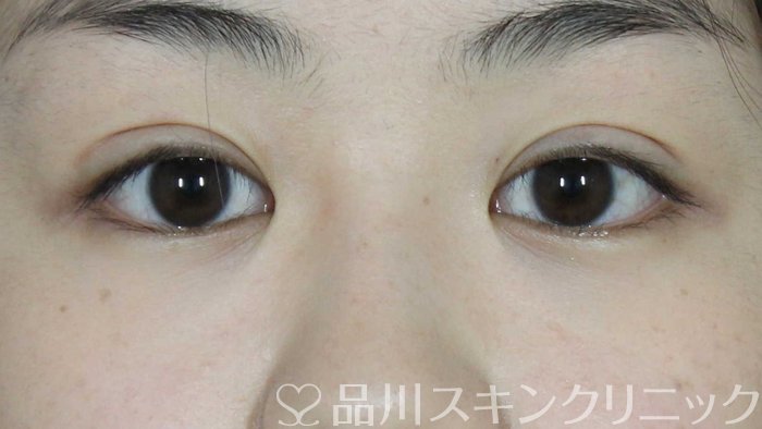 症例NO.72311のAFTER写真