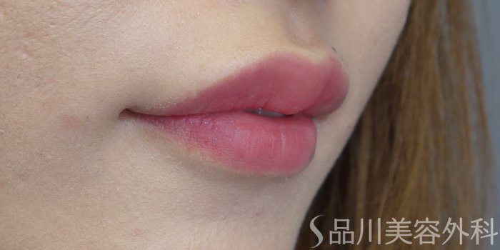症例NO.71519のAFTER写真