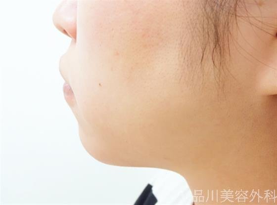 症例NO.33024のBEFORE写真